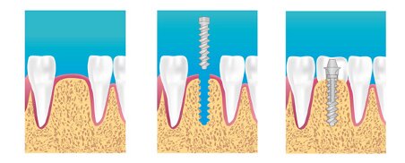 Implant dentaire Sens 89